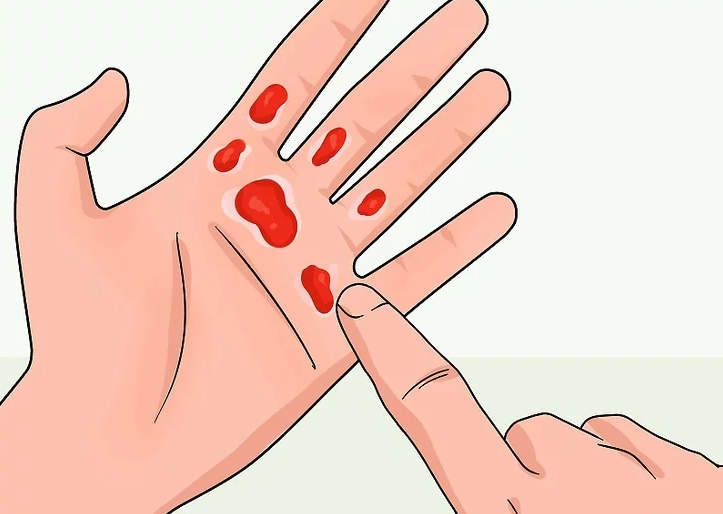 Cần đảm bảo an toàn và tránh bị bỏng lạnh